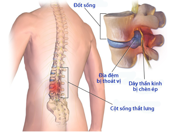 BỆNH THOÁT VỊ ĐĨA ĐỆM CỘT SỐNG VÀ PHƯƠNG PHÁP ĐIỀU TRỊ