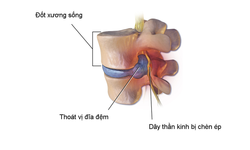 XỬ LÝ ĐĨA ĐỆM TỪ CĂN NGUYÊN